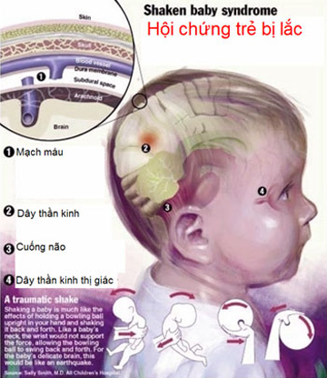 Cẩn thận hội chứng rung lắc ở trẻ 1