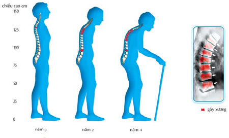 Bệnh hay gặp ở phụ nữ tuổi trung niên 1