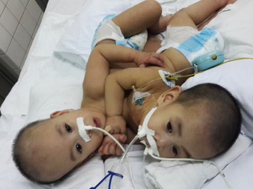 Hai bé song sinh dính nhau quê Ninh Thuận trước khi được phẫu thuật tại Bệnh viện Nhi Đồng 2, TP HCM. Ảnh: Bác sĩ Trương Quang Định.
