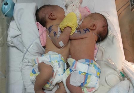 Hai bé gái song sinh dính liền đang được chăm sóc tại bệnh viện Nhi đồng 1.
