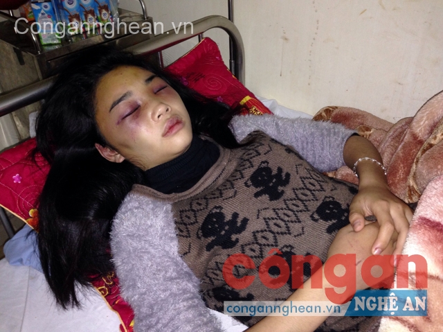 Nữ sinh Trần Thị Anh Thơ với những vết bầm trên mặt và tay