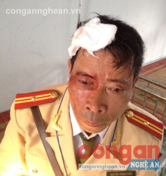 Thiếu tá Phúc với vết thương trên đầu sau khi bị tội phạm chống trả trong dịp Tết vừa qua