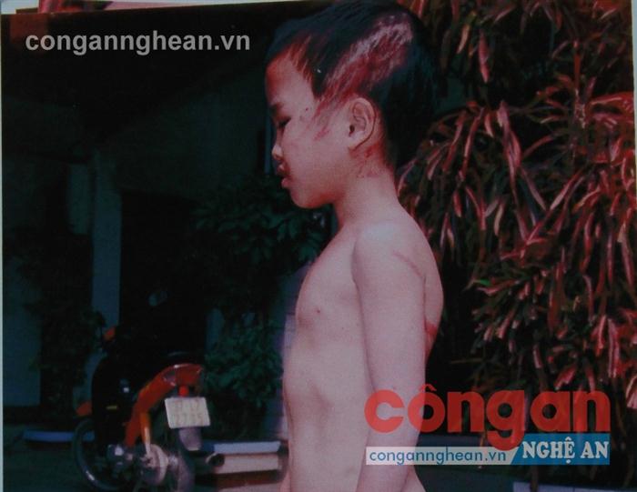 Hình ảnh Quý bị cha ruột bạo hành mà Công an xã Quỳnh Minh lưu lại