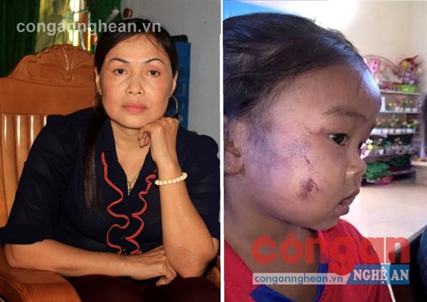 Cô giáo Cao Thị Kiều Nhi và hình ảnh cháu Hiền bị bạo hành được cô Nhi đưa lên mạng xã hội