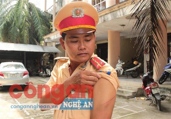 Đồng chí Đại úy Nguyễn Văn Hợi cùng vế thương do các đối tượng gây ra
