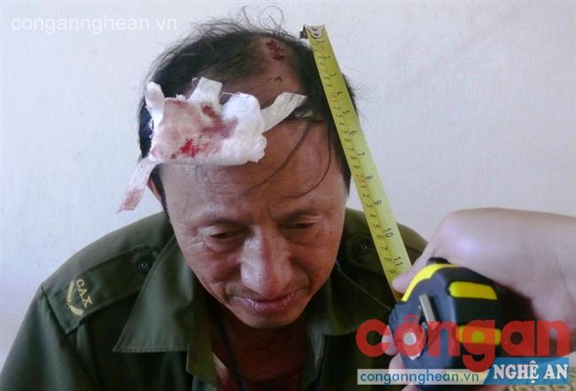 Đồng chí Phạm Ngọc Bình bị thương ở vùng đầu và trán