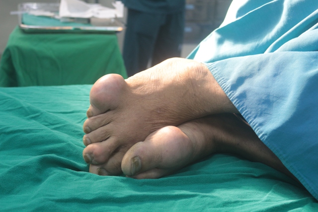 Khớp ngón chân sưng to của một bệnh nhân bị bệnh Gout hơn 15 năm