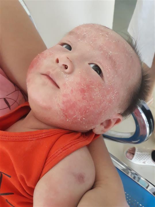 Sau 3 ngày điều trị tại Bệnh viện Quốc tế Vinh, tình trạng da mặt cháu bé đã được cải thiện, sau 1 tuần thì khỏi hẳn