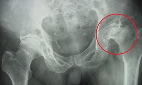 Hình ảnh trên Xquang của hoại tử vô khuẩn chỏm xương đùi