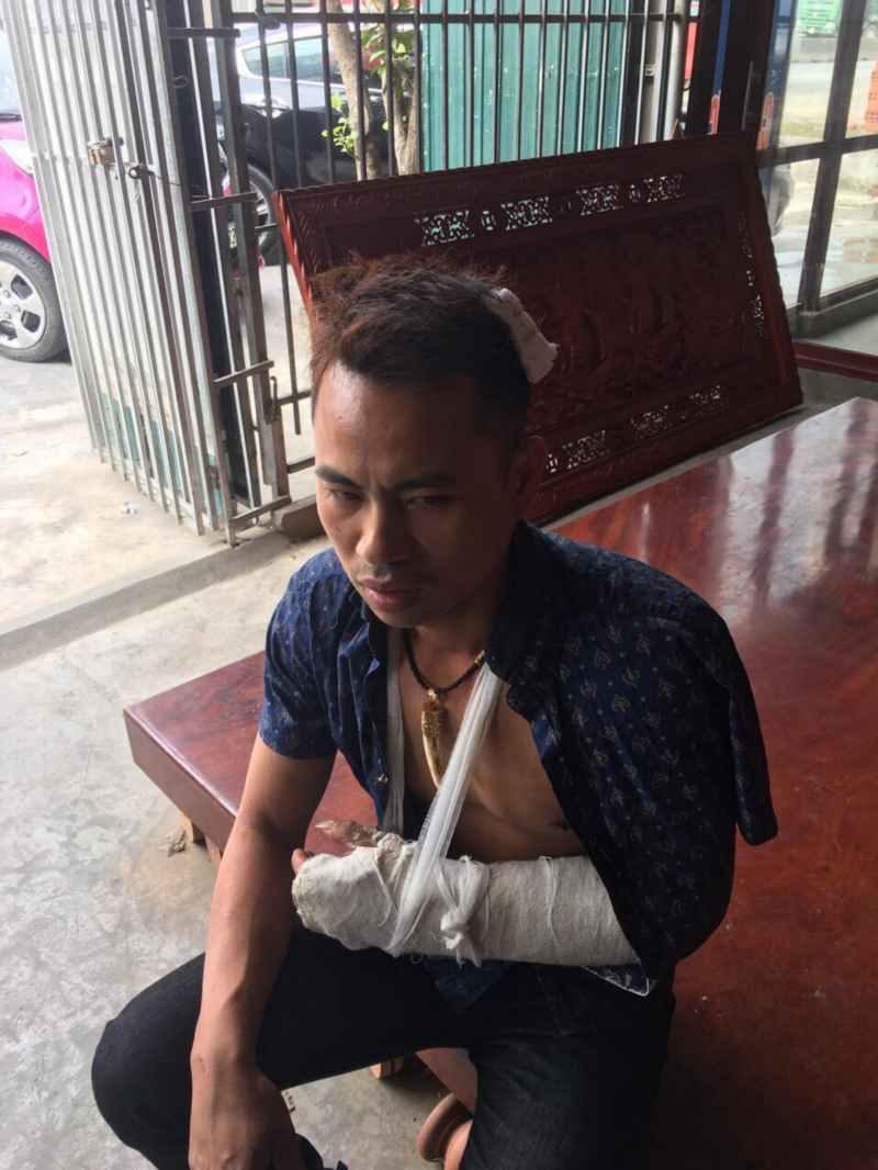 Anh Phạm Văn Thảo bị nhóm đối tượng côn đồ đánh gãy tay