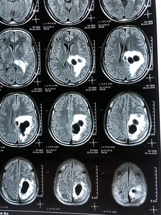 Kết quả chụp CT não của bệnh nhân cho thấy có 5 ổ sán nằm rải rác trong não. Ảnh: BVCC