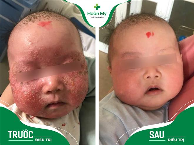 Viêm da cơ địa ở trẻ em nếu không được điều trị kịp thời có thể dẫn đến nhiễm trùng, tổn thương ngoài da để lại sẹo vĩnh viễn
