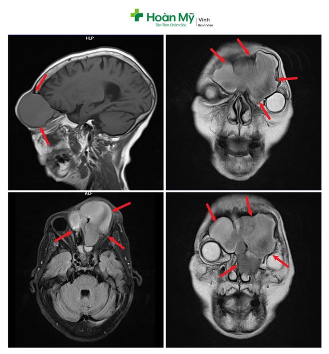 Hình ảnh khối u kích thước 75x72x56mm (mũi tên) trên kết quả Chụp cộng hưởng từ MRI.