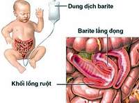 Cách phát hiện và ngăn ngừa lồng ruột ở trẻ 1