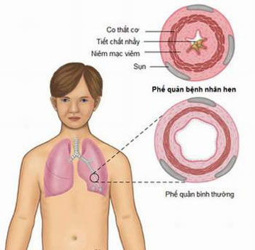 Phòng tránh cơn hen cho trẻ 1