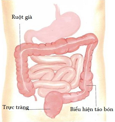 Không tự ý dùng thuốc trị táo bón 1