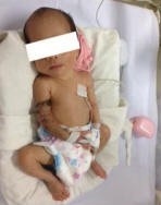 Điều trị thành công ca tắc tĩnh mạch ở trẻ sơ sinh