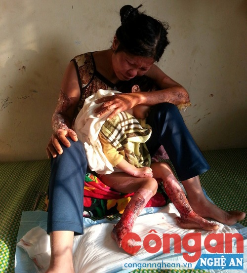 Chị Hiền và cháu Na đang điều trị tại Bệnh viện Đa khoa Tân Kỳ