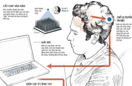 Công nghệ cấy chip vào não giúp người bại liệt vận động
