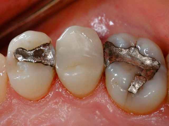 Hàn răng nhiều rất dễ nhiễm độc thủy ngân