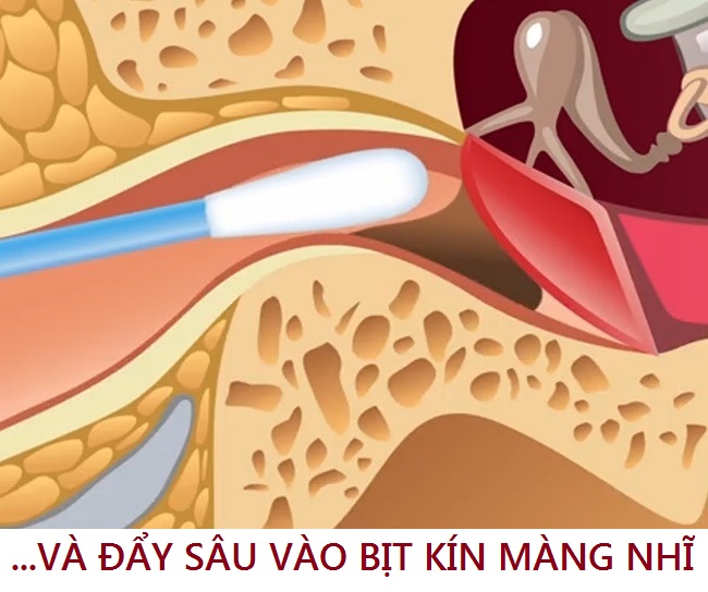 Tại sao không cần phải lấy ráy tai?!