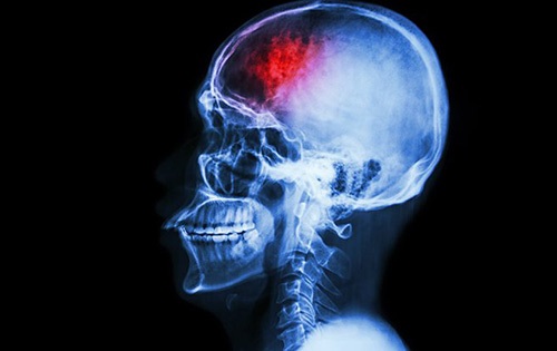 Vi khuẩn ruột có thể gây tổn thương não, đột quỵ