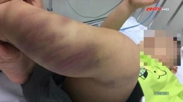 Khởi tố điều tra vụ bé trai nhập viện trong tình trạng nguy kịch