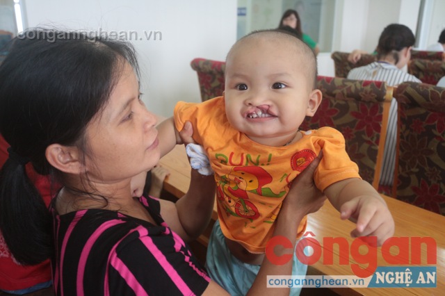 Cứ 500 trẻ em sinh ra có một em bị dị tật hàm mặt