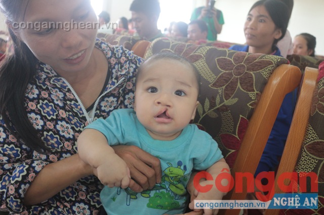 Phẩu thuật miễn phí cho 100 trẻ em bị dị tật hàm mặt