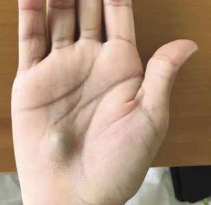 Phát hiện bướu lạ ở tay, suýt chết vì chứng bệnh nguy hiểm