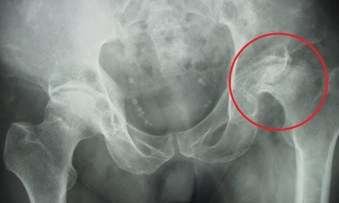 Hoại tử chỏm xương đùi do lạm dụng rượu bia, thuốc lá
