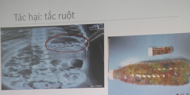 Hình chụp X-quang tình trạng trẻ bị tắc ruột khi ăn phải hạt nở và chai hạt nở có bán trên thị trường.