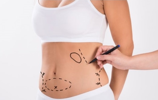 Cảnh giác với quảng cáo hút mỡ làm đẹp