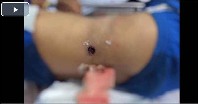 Đi săn bị súng cướp cò bắn vào bụng
