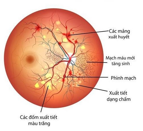 Thiết kế, chế tạo máy soi đáy mắt điện tử hỗ trợ phát hiện mù lòa