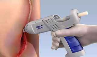 Súng bắn keo sinh học chữa lành vết thương