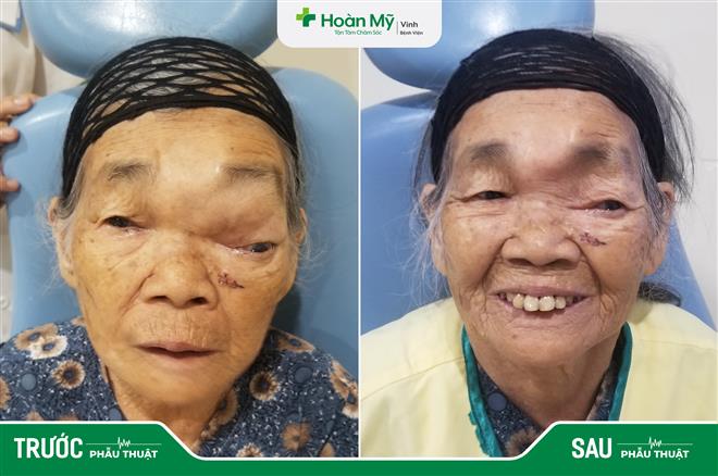 Người bệnh trước và sau khi phẫu thuật.