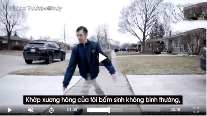 Cuộc sống phi thường của người đàn ông có đôi chân hình chiếc kéo