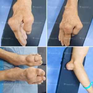 Biến dạng tứ chi vì bệnh gout