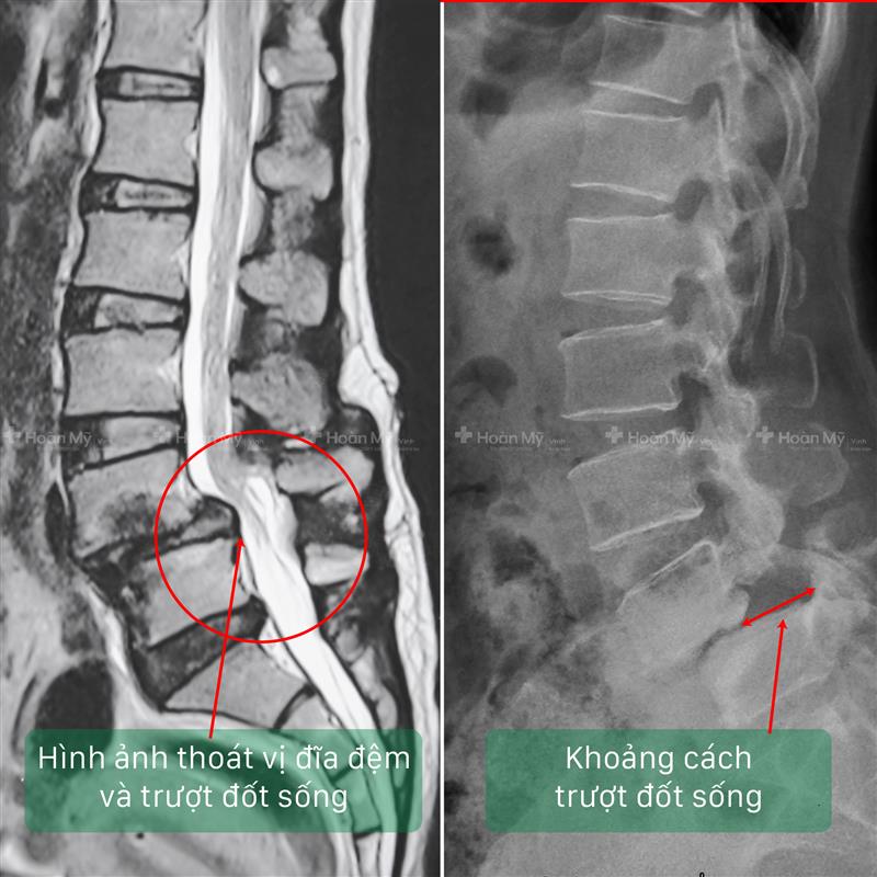 Hình ảnh chẩn đoán bệnh lý qua phim X-Quang và phim MRI (Cộng hưởng từ)